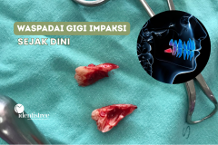 WASPADAI GIGI IMPAKSI SEJAK DINI