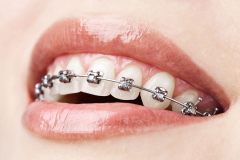 ORTHODONTIC TREATMENT