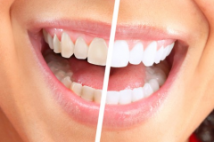 DENTAL VENEER
