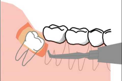 ODONTECTOMY