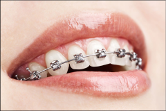 SELF-LIGATING BRACES