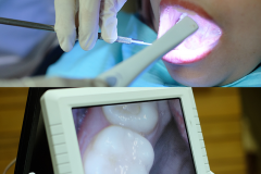 INTRA ORAL CAMERA